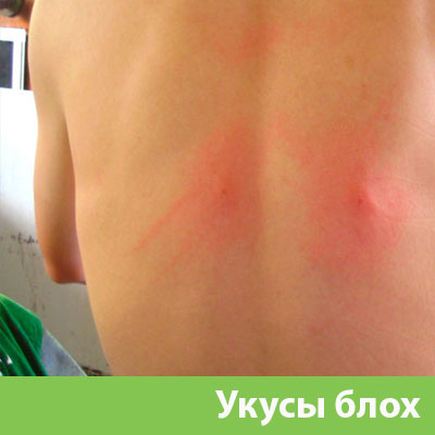 Укусы блох в Электростали