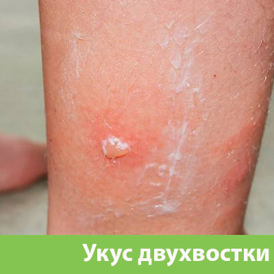 Укус двухвостки в Электростали