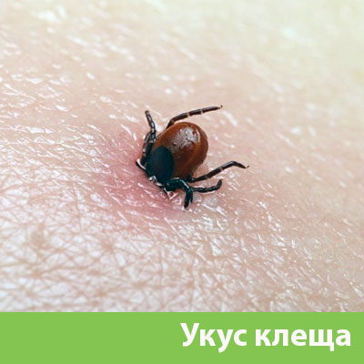 Укус клеща в Электростали