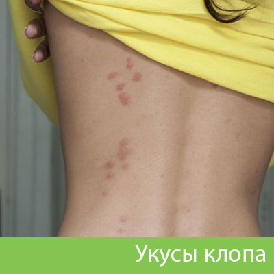 Профессиональное уничтожение клопов в Электростали